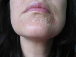 Day 5 peel 1